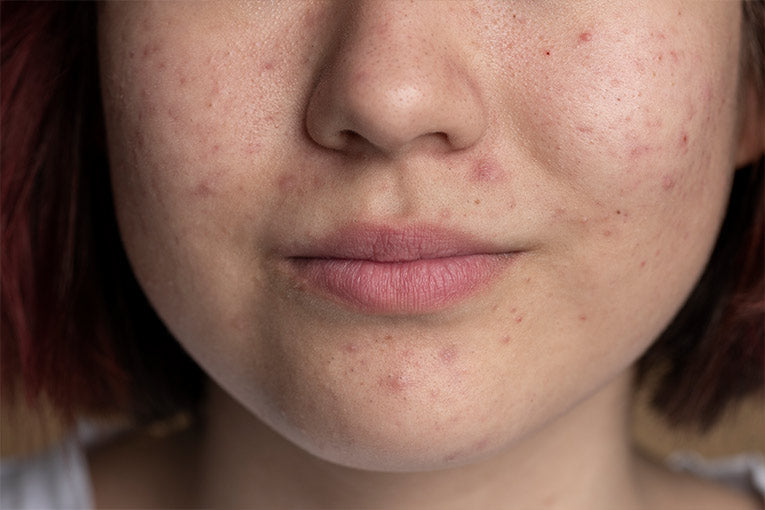 Early Signs of Lupus in Females