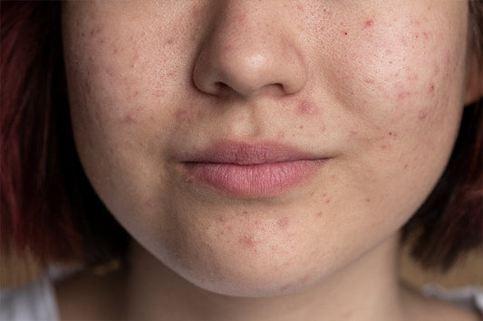 Early Signs of Lupus in Females