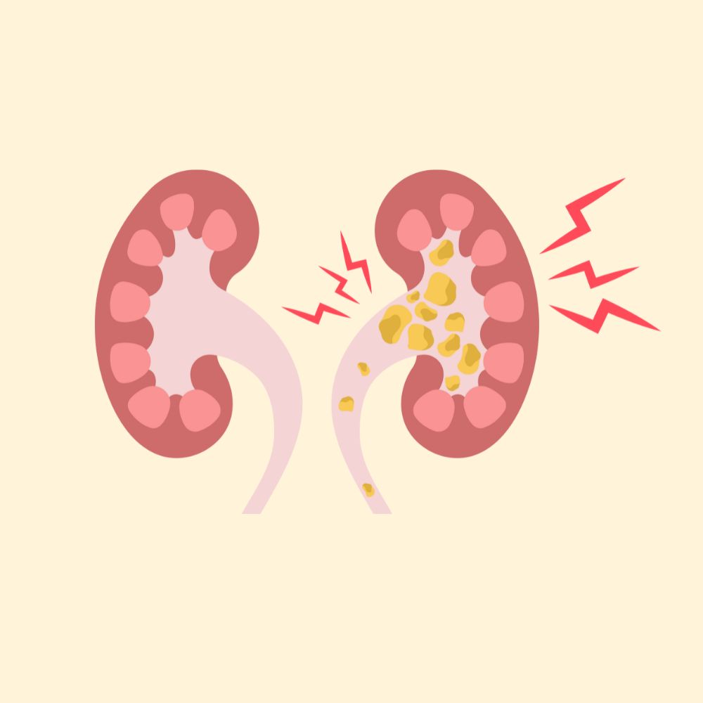 Hydronephrosis