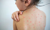 Measles