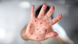 Hand, Foot, and Mouth Disease in Australia: Symptoms, Causes, and Prevention
