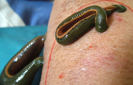Raktamokshana Treatment