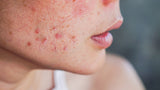 Rejuvenate Your Skin with Ayurvedic Blemish Treatment