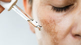 Hyperpigmentation: Causes, Symptoms, and Ayurvedic Treatment