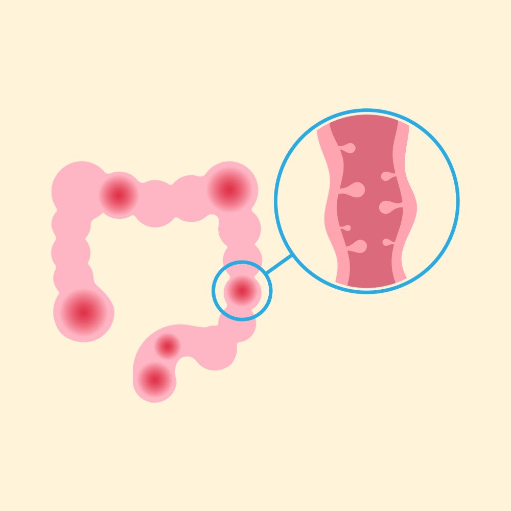 Irritable Bowel Syndrome