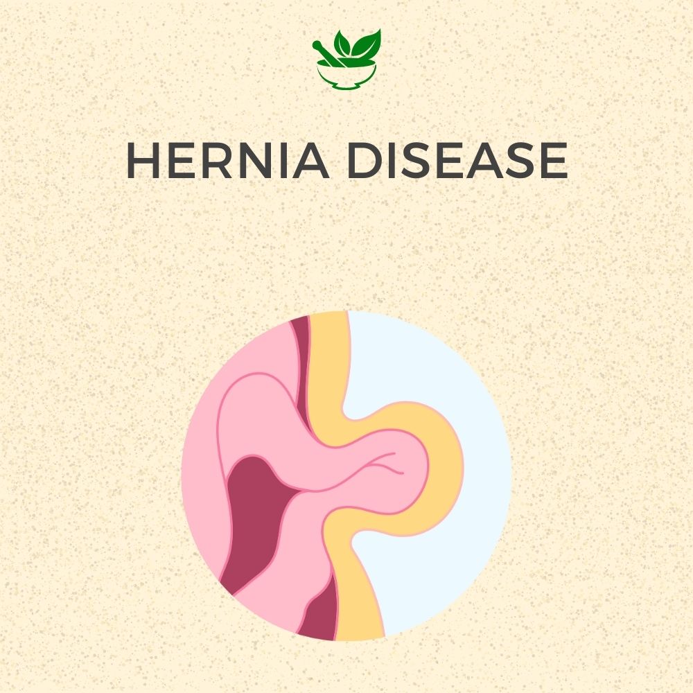 Hernia Ayurvedic Management Consultation