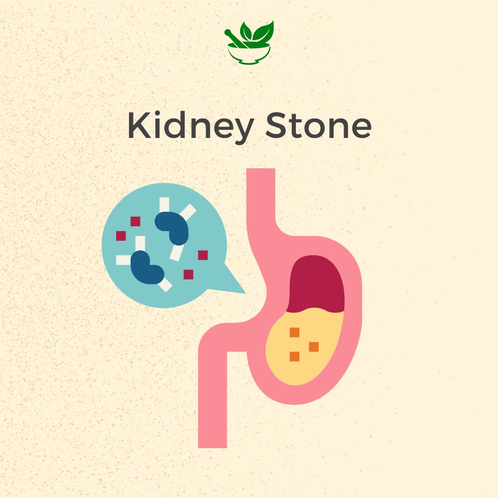 Kidney Stone Ayurvedic Mangement Ayurvedic Consultation - deepayurvedaaustralia