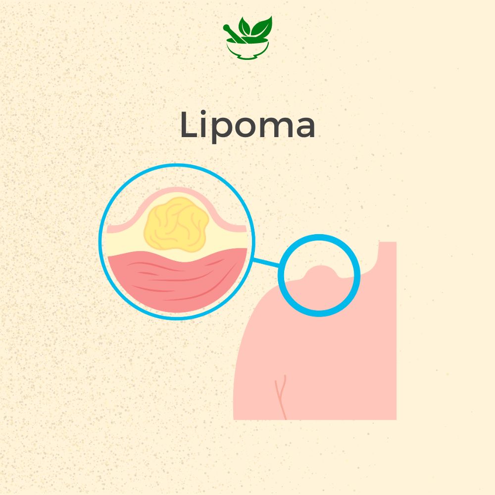 Lipoma Ayurvedic Mangement Ayurvedic Consultation - deepayurvedaaustralia