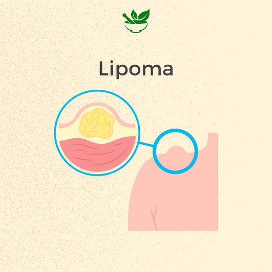 Lipoma Ayurvedic Mangement Ayurvedic Consultation - deepayurvedaaustralia